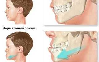 Микрогнатия (маленькая нижняя челюсть): причины, симптомы, лечение