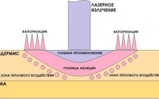 Лазерное лечение акне: описание и эффективность процедуры
