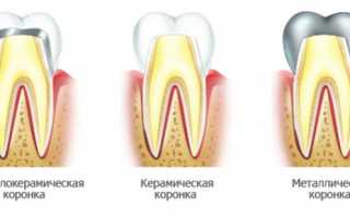 Как лечить боль и воспаление десны под коронкой правильно