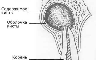 Тимофеев 1-3 том / том 3 / 25. КИСТЫ ЧЕЛЮСТЕЙ / 25.1. РАДИКУЛЯРНЫЕ КИСТЫ