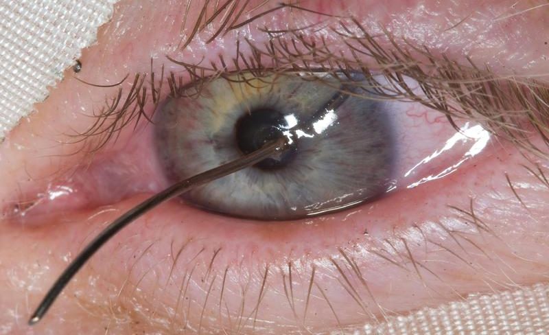 Лопнул сосуд в глазу - что делать