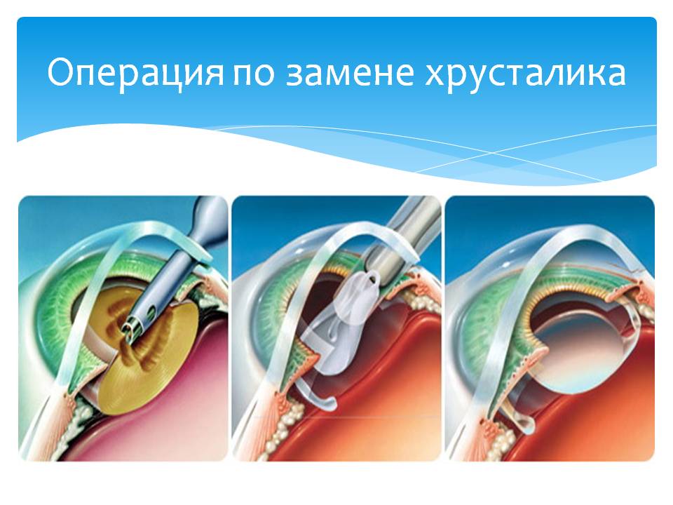 Операция по замене хрусталика глаза