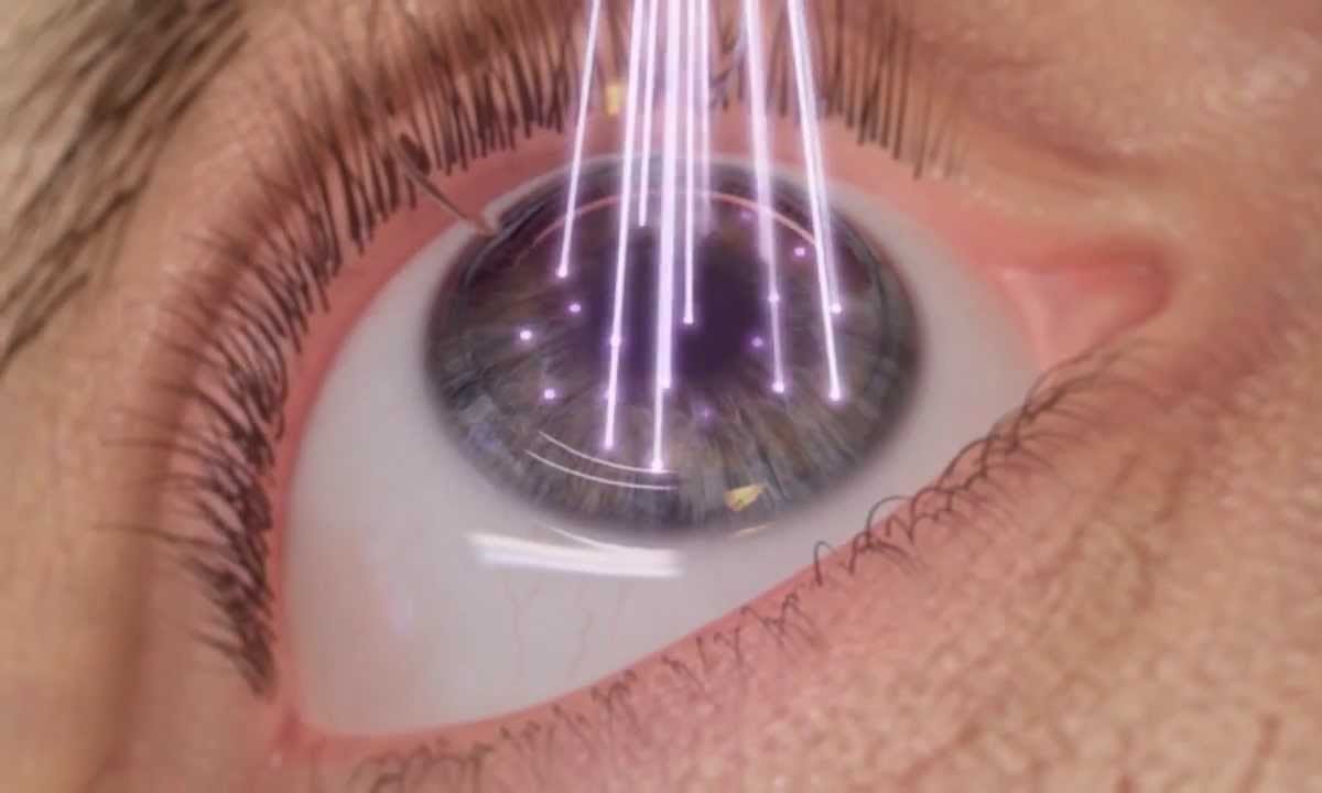 Лазерная коррекция зрения методом ФРК