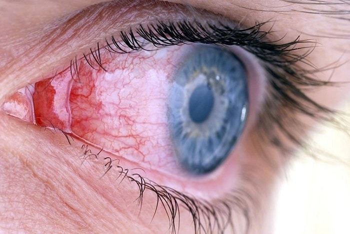 Покраснение роговицы