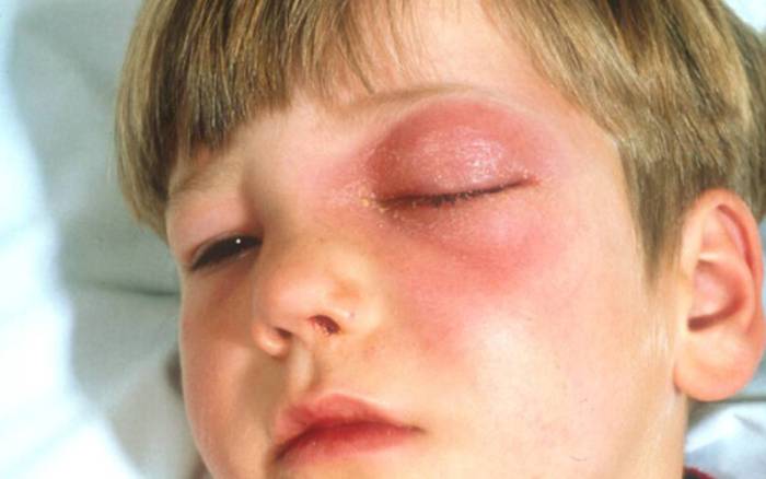 Что такое флегмона глазницы