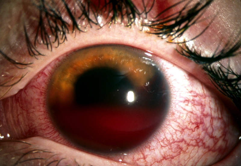 Гифема или кровоизлияние в переднюю камеру глаза