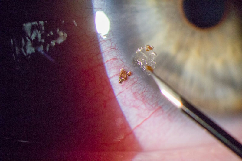 Как достать окалину из глаза