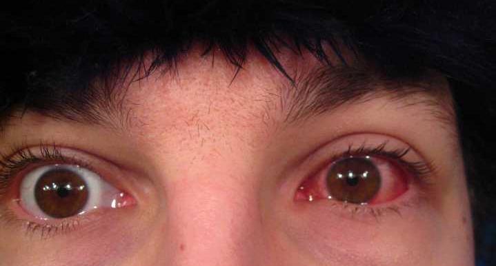 Аденовирус