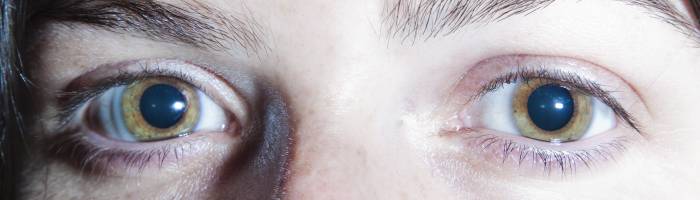Как избавиться от расширенных зрачков