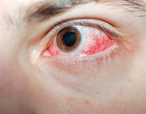Ожог роговицы глаза