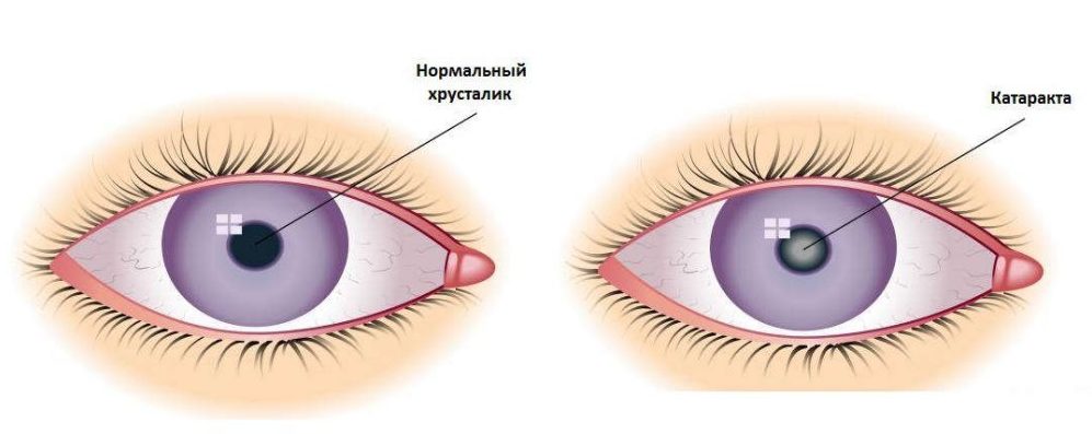 Что такое помутнение хрусталика глаза