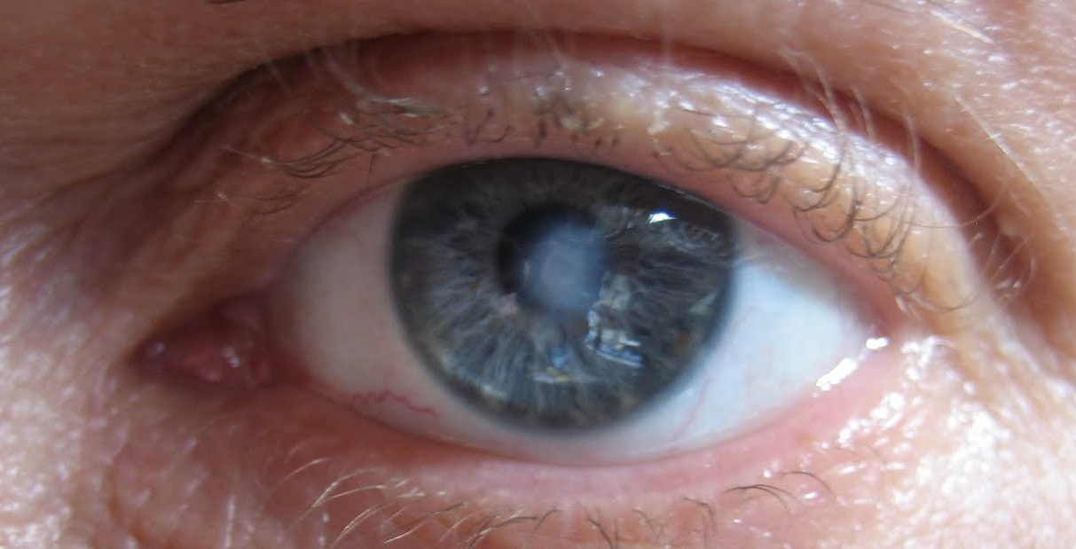 Лейкома роговицы глаза