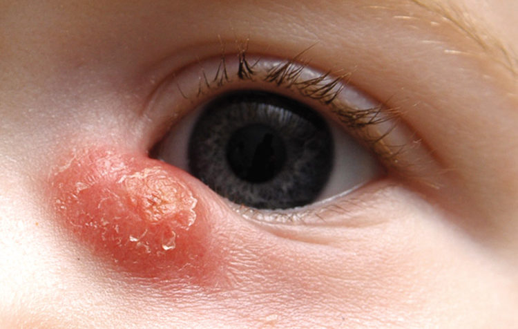 дакриоцистит