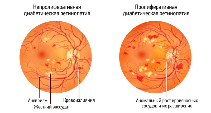 Диабетическая ретинопатия