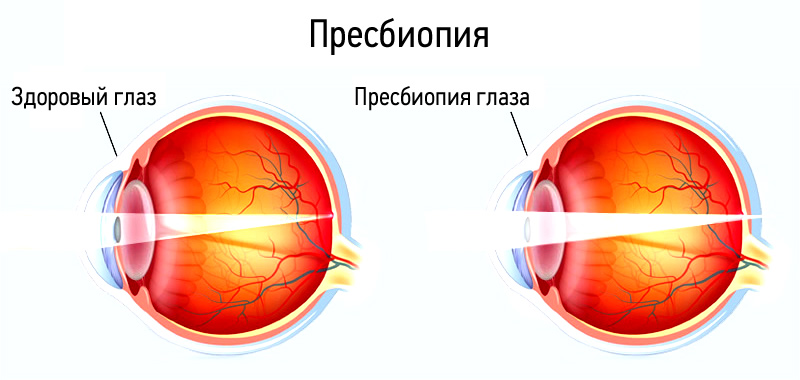 Нарушение зрения