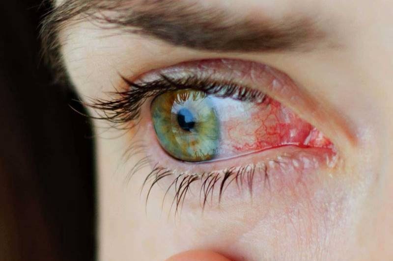 Острый конъюнктивит