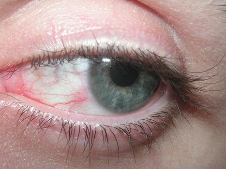 Болезнь Шегрена