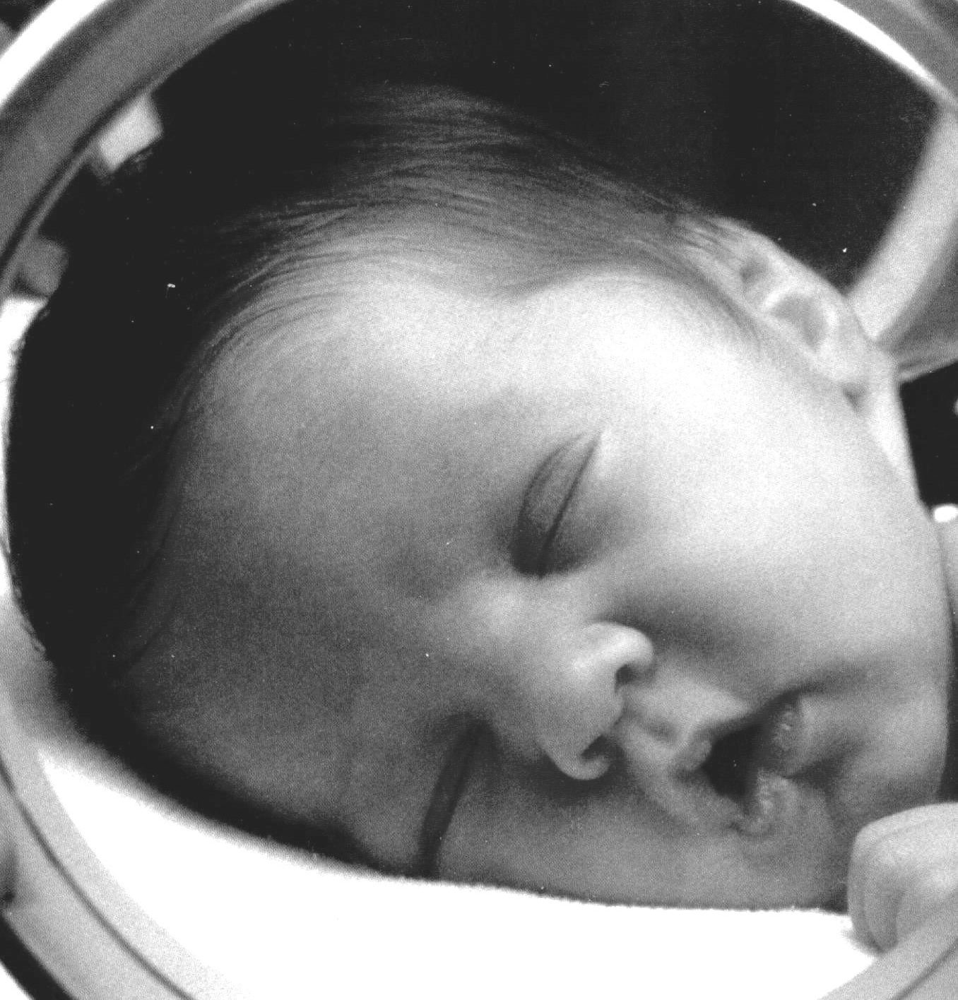 Ретинопатия недоношенных