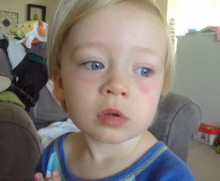 Комаровский о красноте под глазами у детей