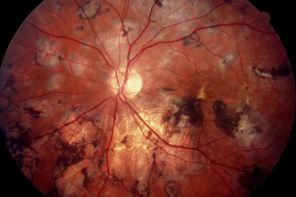 Хориоретинит