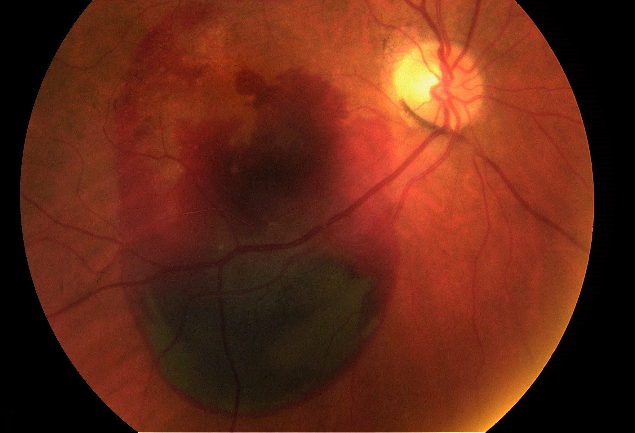 Почему зрение как в тумане