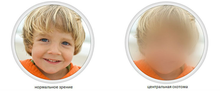 Что такое скотома глаза