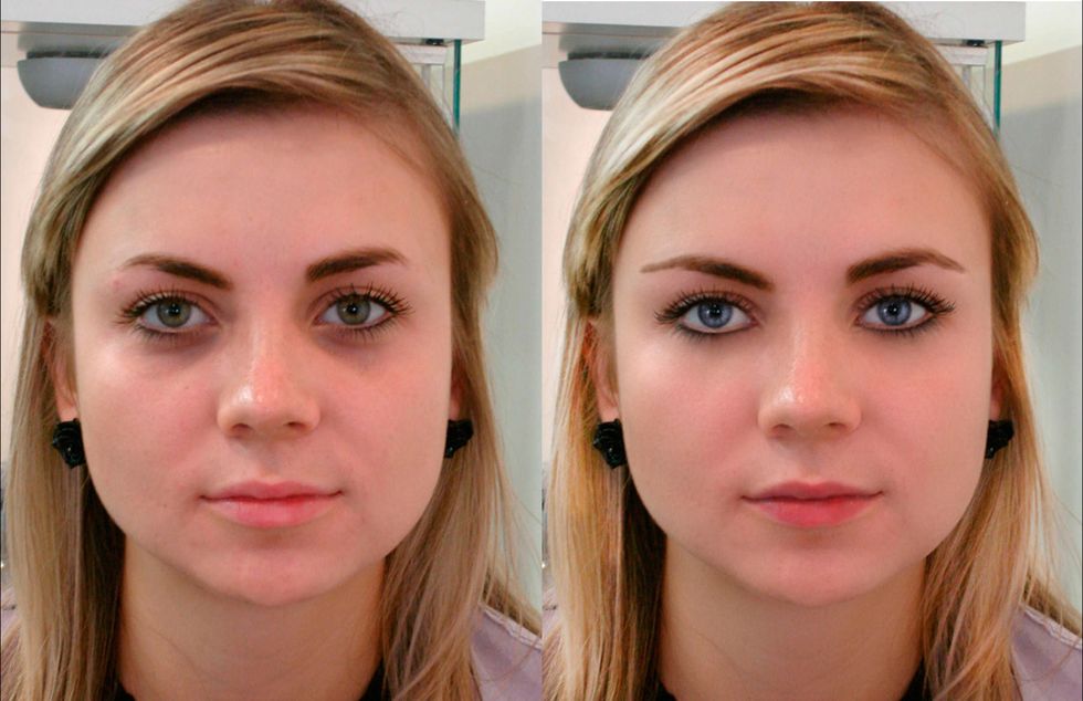 Проведение мезотерапии