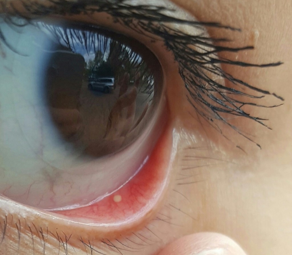 Прыщ на внутренней стороне века