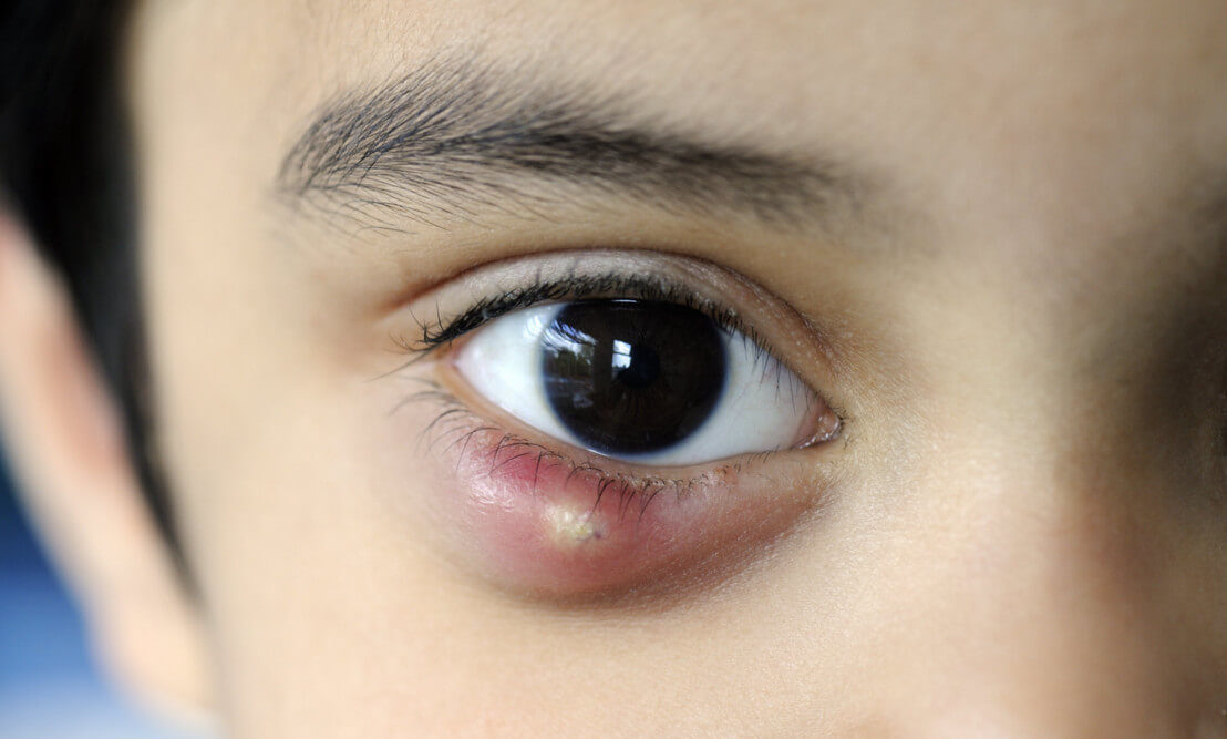 Ячмень на глазу у ребенка