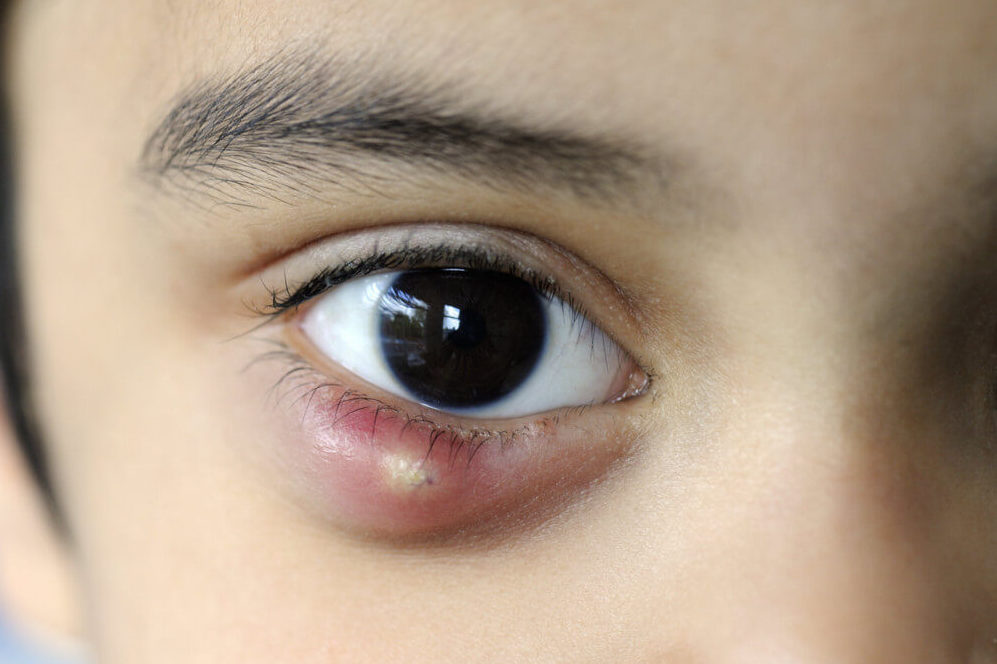 Ячмень на глазу у ребенка