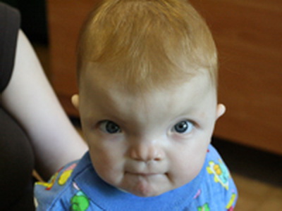 Гипертелоризм