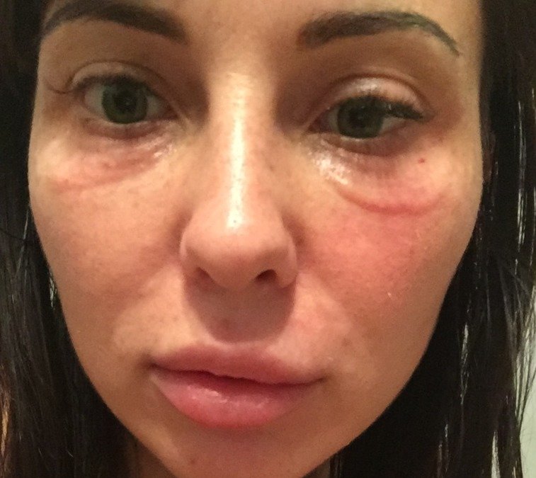 Причины отечности вокруг глаз