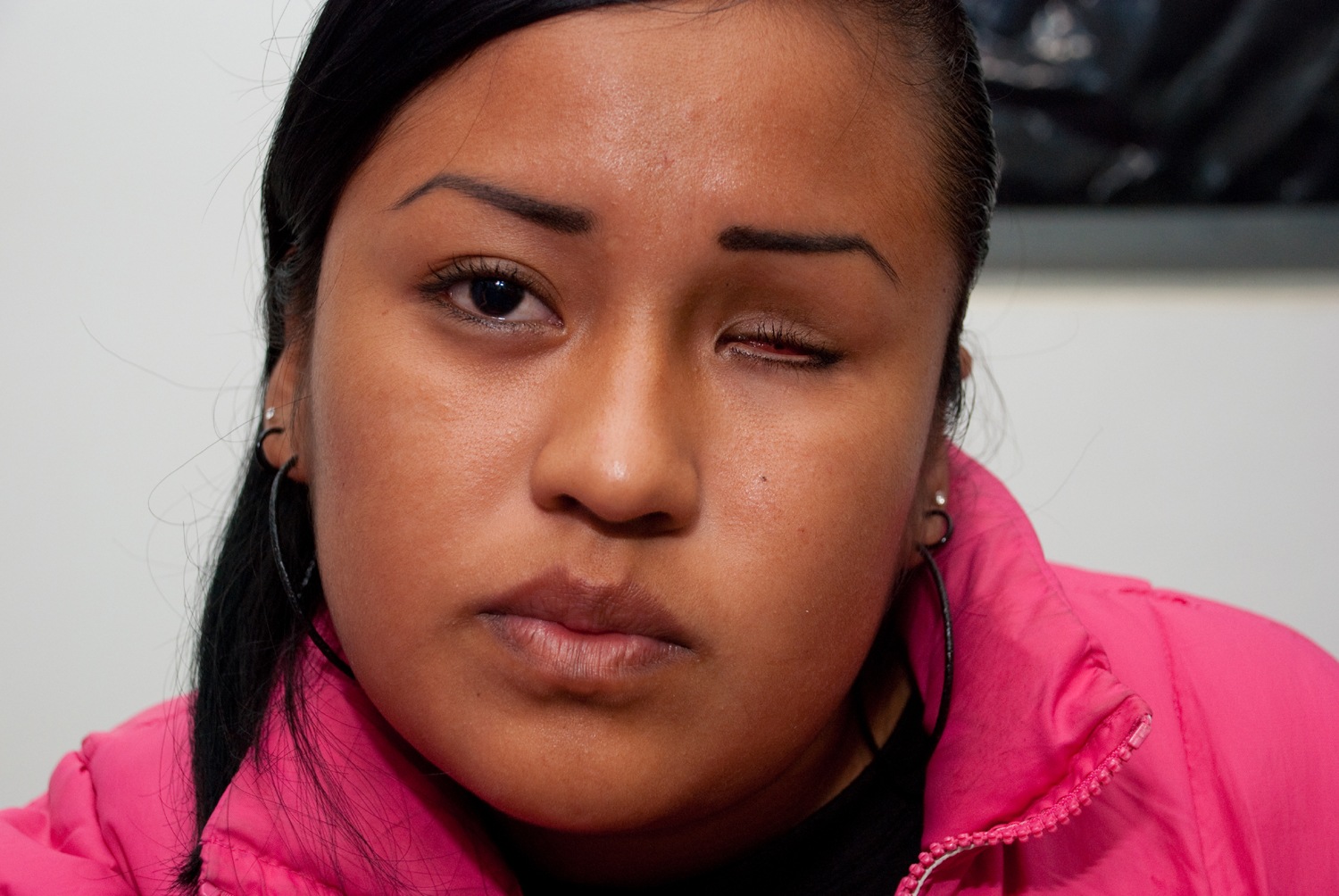 Дают ли инвалидность за отсутствие одного глаза