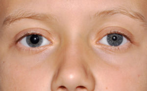 Зрачки разные по размеру