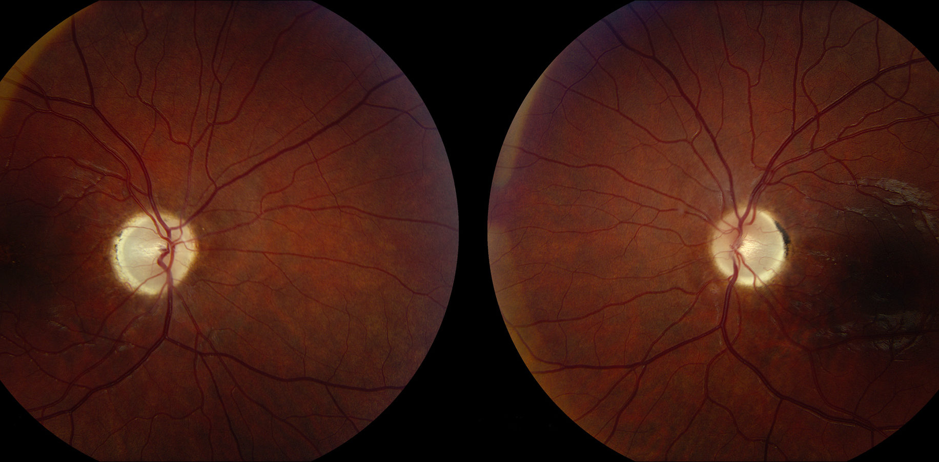 Атрофия зрительного нерва - лечение частичной и полной атрофии