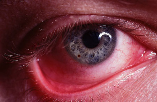 Метастатическая офтальмия