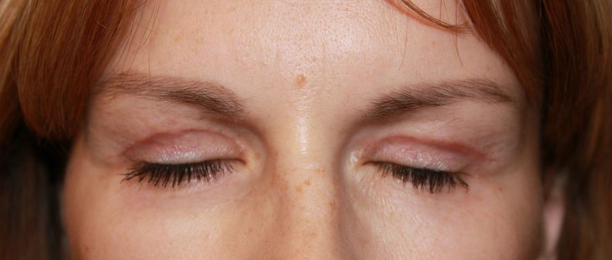 Швы после блефаропластики