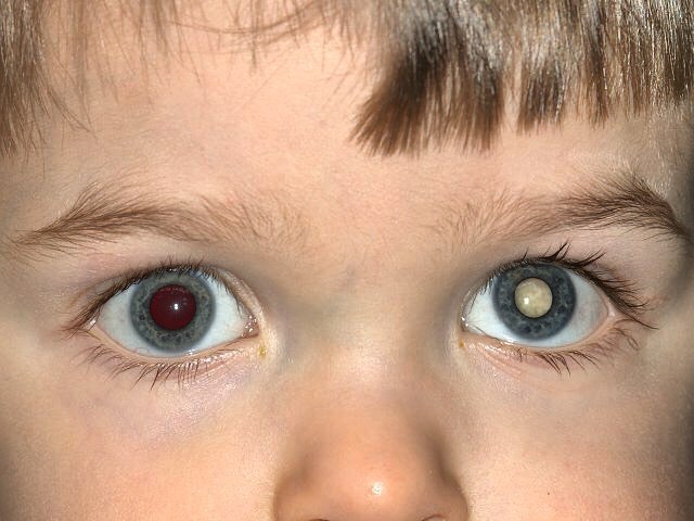 Ретинобластома - рак сетчатки глаза