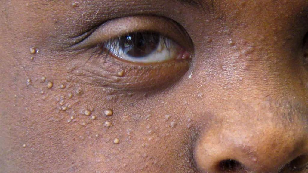 Электрокоагуляция