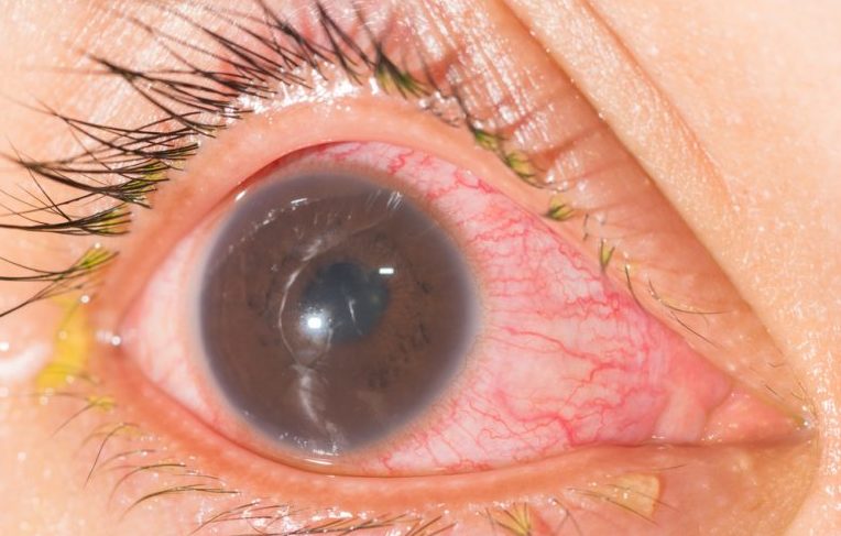 Что такое ангиосклероз сетчатки глаза