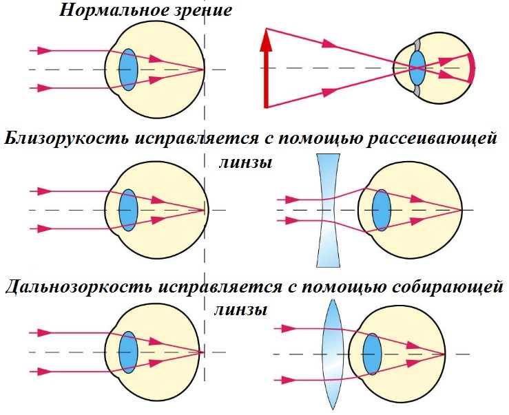Миопия и гиперметропия одновременно