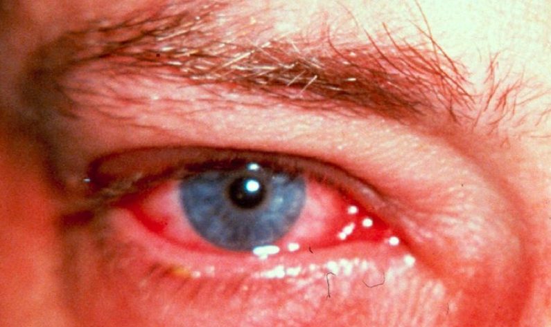 Что такое электроофтальмия