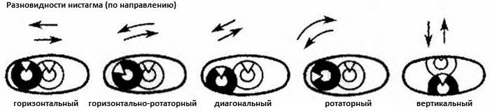 Нистагм у новорожденных и детей от 1 года