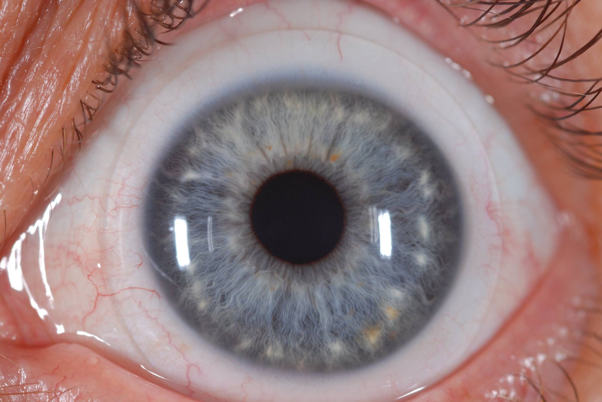 тонкая роговица