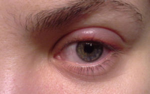 глаз красный