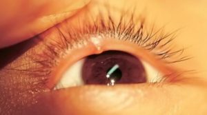 Герпетическая инфекция