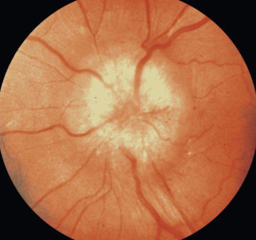 Застой диска зрительного нерва