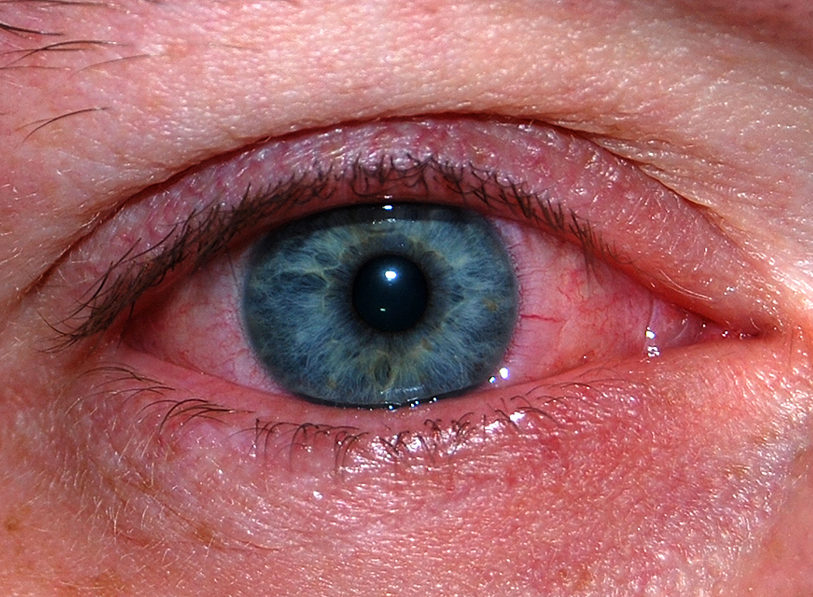 chto-delat-esli-goryachee-maslo-popalo-v-glaz