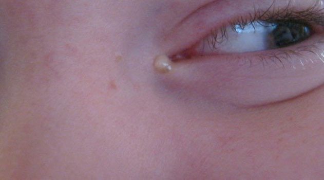 Почему в уголках глаз появляются белые выделения