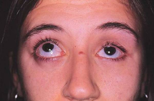 Западение глазного яблока